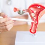 homeopathic treatment for fibroids in uterus