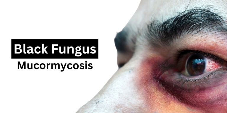 homeopathic medicine for black fungus