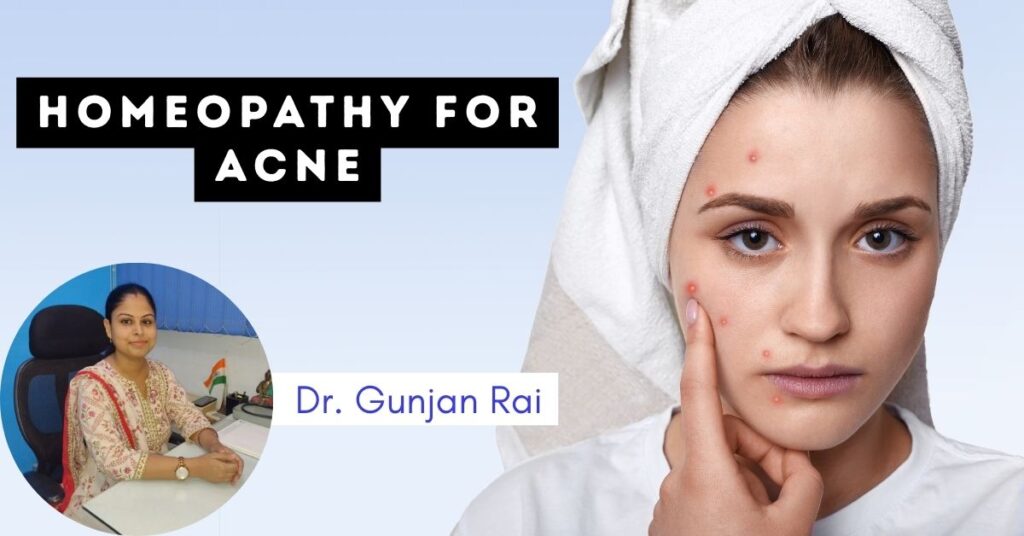 homeopathic medicines for acne
