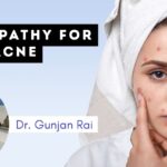 homeopathic medicines for acne