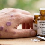 Homeopathic medicine bottles placed near skin rash on patient's arm for Lichen Planus treatment