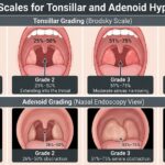 A medical illustration chart showing the visual appearance of four grades of enlarged tonsils (top) and the physical obstruction in nasal endoscopy views of four grades of enlarged adenoids (bottom).